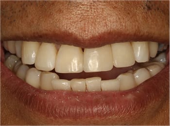 Composite Restorations