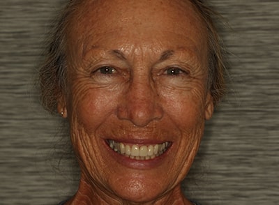 Patient smiling after Invisalign treatment